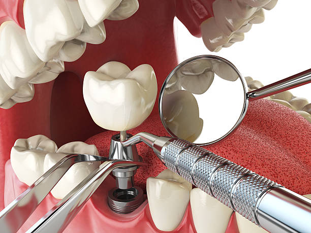 Best Emergency Denture Repair in Woodmore, MD